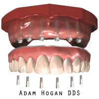 Full Implant Choice/ The Atlantic Implant Institute Logo